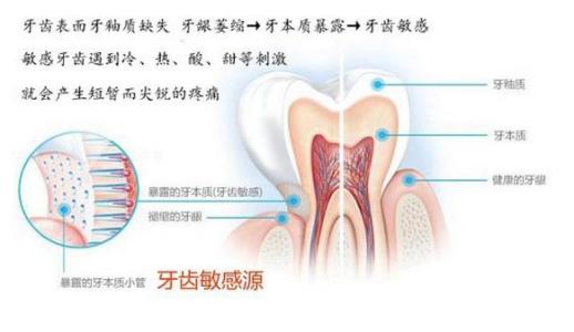 牙齿过敏疼痛吃什么药 牙齿过敏是什么原因