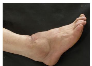 足踝骨性关节炎 足踝关节炎怎么治疗