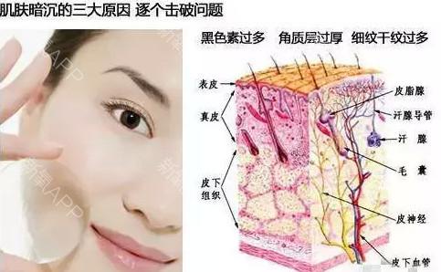 闭合性粉刺用什么卸妆 闭合性粉刺是怎么形成的