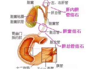 肝结石钙化是什么意思 肝结石是什么原因