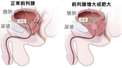 预防前列腺最好方法 预防前列腺增生的方法