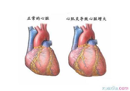 小儿心肌炎怎么引起 心肌炎是怎么形成的