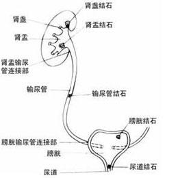 尿结石是如何引起的 尿结石什么原因