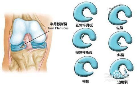 半月板损伤的最好治疗 半月板损伤最佳治疗方法