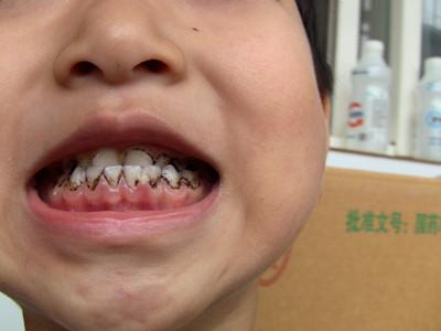 孩子牙齿上有白斑 孩子牙齿发黑怎么回事