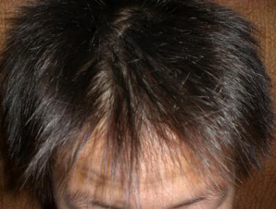 治疗头发稀少的方法 治疗头发稀少怎么做_治疗头发稀少有什么方法