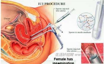 人工流产后注意事项 什么是人工受精 人工受精的注意事项