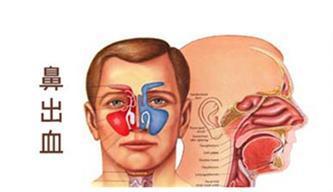 流鼻血是什么病的前兆 鼻子出血怎么回事