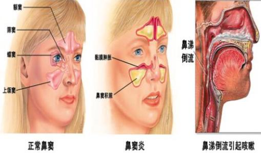 老中医治疗鼻窦炎 鼻窦炎中医治疗方法