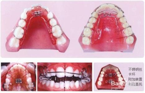 美容冠矫正牙齿过程 牙齿矫正有几种方法