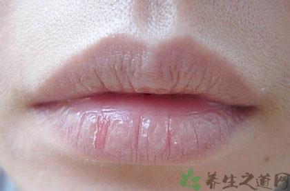 嘴唇起皮是什么原因 嘴唇起皮是什么原因_嘴唇起皮的原因