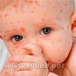 宝宝脸上有小红点 宝宝脸上长红点怎么办 宝宝脸上长小红点护理方法