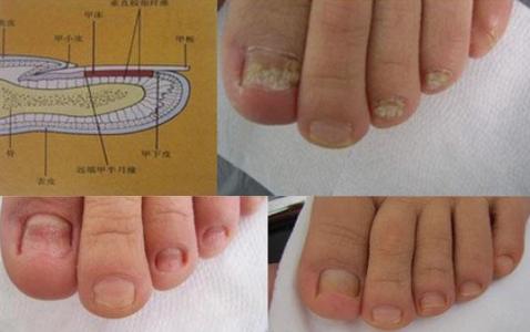 昆明灰指甲的治疗方法 灰指甲的治疗方法_治疗灰指甲的方法