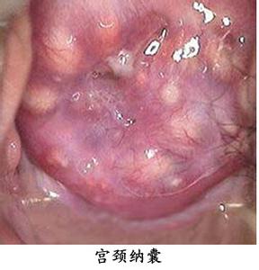 宫颈纳囊是怎么得的 宫颈纳囊是怎么形成的