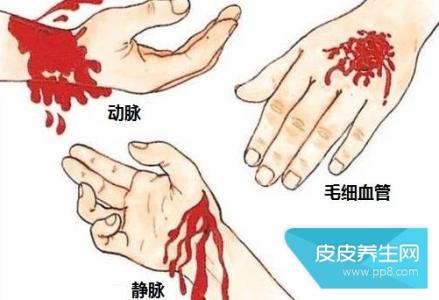 出血的初步急救处理 出血的处理方法