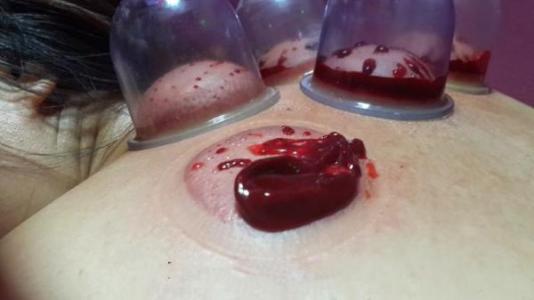 拨罐出血是什么原因 拨血罐淤血是什么原因
