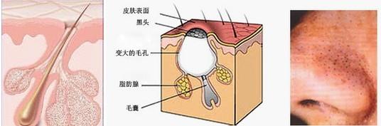 毛孔堵塞是什么引起的 毛孔堵塞是什么原因