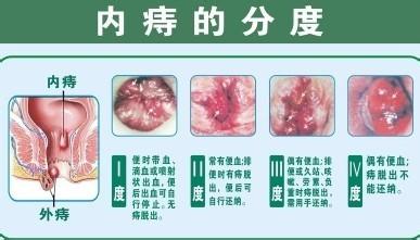 pph痔疮手术后注意事项 痔疮手术后的注意事项