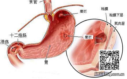 胃病是什么原因引起的 什么原因得胃病