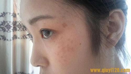 脸上长斑如何去除偏方 有什么偏方能治疗脸上的斑