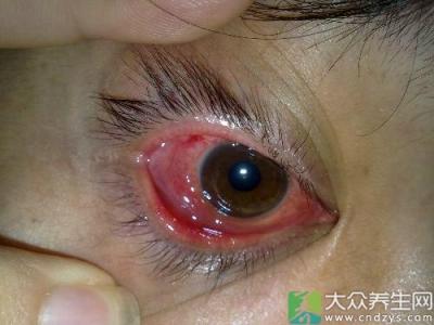 眼睛干痒用什么眼药水 眼睛干痒是怎么回事