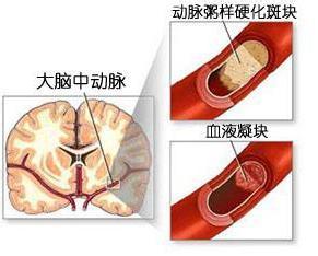 脑血栓急救三分钟 脑血栓急救方法