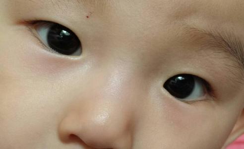 小孩缺什么会有黑眼圈 小孩黑眼圈怎么办