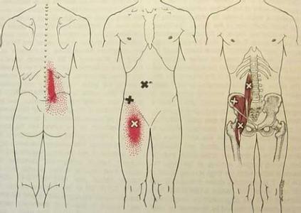 腰肌筋膜炎可以自愈吗 腰筋膜炎治疗方法