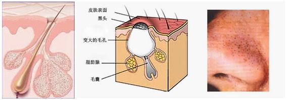 如何去黑头土方法 去黑头土方法