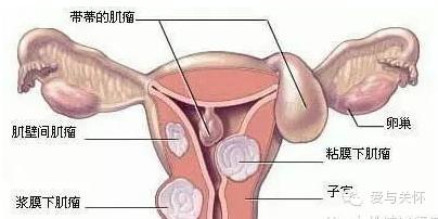 子宫切除后如何锻炼 子宫切除后如何排毒