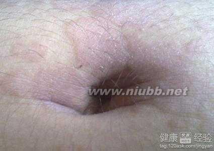 肚脐外围痒是怎么回事 肚脐眼痒是怎么回事