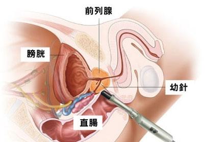 治疗前列腺炎的好方法 什么方法治疗前列腺炎