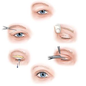 割双眼皮哪种恢复的快 割双眼皮的方法