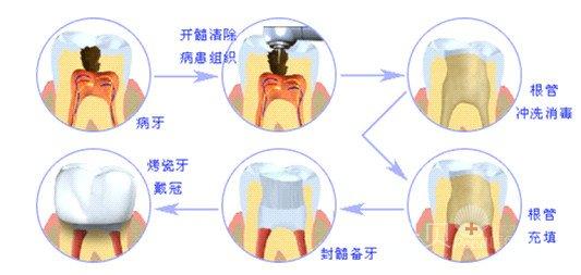 牙齿根管治疗步骤图 牙齿根管治疗的步骤