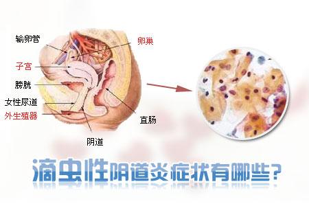 滴虫性前列腺炎 滴虫性前列腺炎是什么