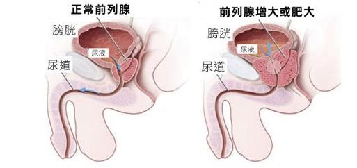 男人得前列腺什么原因 前列腺什么原因