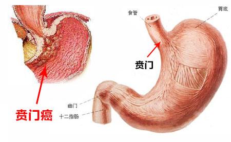 喷门癌的病因 贲门癌的病因