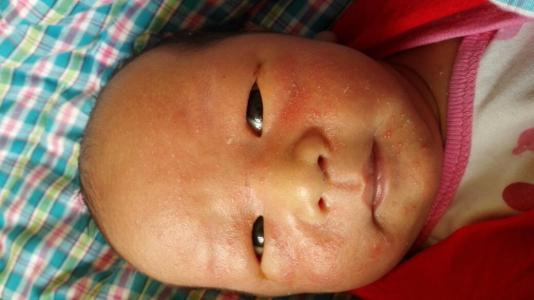 脸上长红疹是什么原因 宝宝出红疹什么原因