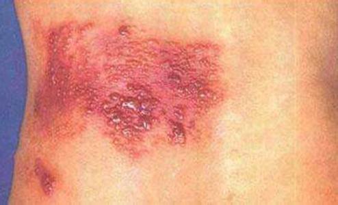 引发带状疱疹的原因 带状疱疹痒怎么原因