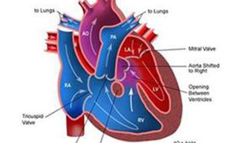 肺心病的原因 肺心病形成的原因