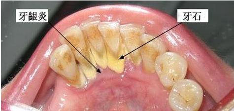 怎么预防牙结石 牙结石是怎么形成的 牙结石的预防和治疗