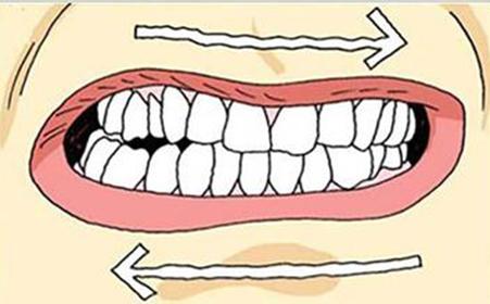 睡觉磨牙的治疗方法 磨牙是什么原因