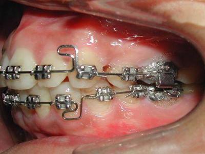 龅牙矫正方法 龅牙矫正的方法有哪些