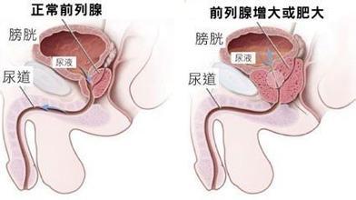 治前列腺增生特效药 什么是前列腺增生