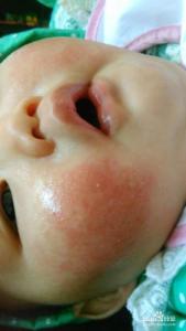 新生儿湿疹形成原因 新生儿湿疹用什么药 引起新生儿湿疹的原因