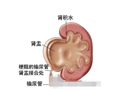 什么原因引起肾积水 肾积水的原因有哪些