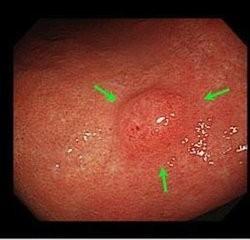 多发性胃息肉能根治吗 胃息肉是怎么回事