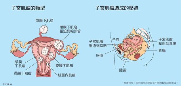 什么原因引起附件囊肿 什么原因导致子宫肌瘤