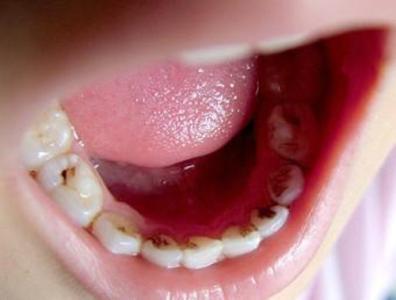 牙齿发炎疼痛怎么止痛 牙齿发炎疼痛怎么办