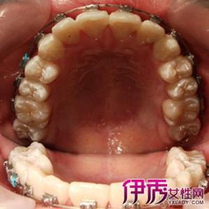 口腔溃疡的治疗方法 口腔上颚溃疡的治疗方法